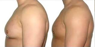 Gynecomastia in Dubai